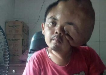 Tak Punya Uang, Penderita Tumor Ganas di Pesisir Selatan Kehabisan Obat