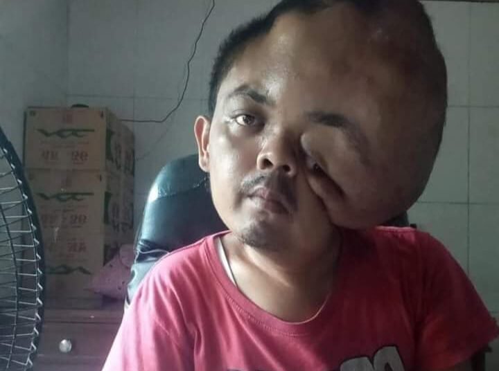 Viqri Gunawan (27), penderita tumor ganas, warga Kampung Duku, Nagari Duku, Kecamatan Koto XI Tarusan, Pesisir Selatan. Foto: IST