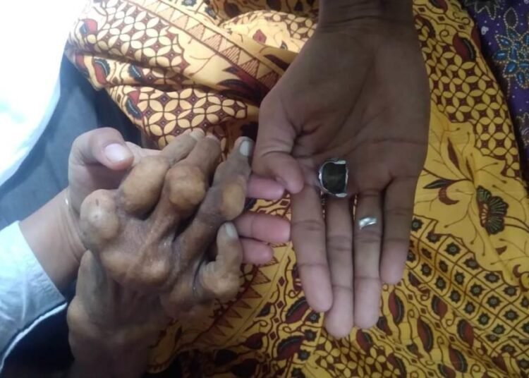 Petugas Damkar Pasaman melepaskan cincin dari jari manis tangan kanan seorang mayat di Pasar Dalik, Jorong Kampung Nan VI, Nagari Aia Manggih Utara, Kecamatan Lubuk Sikaping, Pasaman, Sabtu (26/7) pagi. Foto: Damkar Pasaman