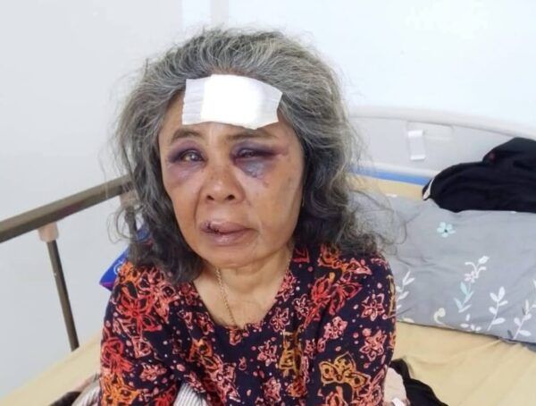 Saudah, korban penganiayaan di tepi sungai Sibinail, Kampung Lubuk Aro, Nagari Padang Mantinggi Utara, Kecamatan Rao, Pasaman, dirawat di RSUD Tuangku Imam Bonjol Lubuk Sikaping.