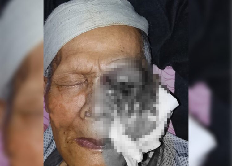 Seorang pria lanjut usia (lansia), Gusnali (76), warga Nagari Surian, Kecamatan Pantai Cermin, Kabupaten Solok, Sumatera Barat, didiagnosis menderita tumor ganas pada mata.